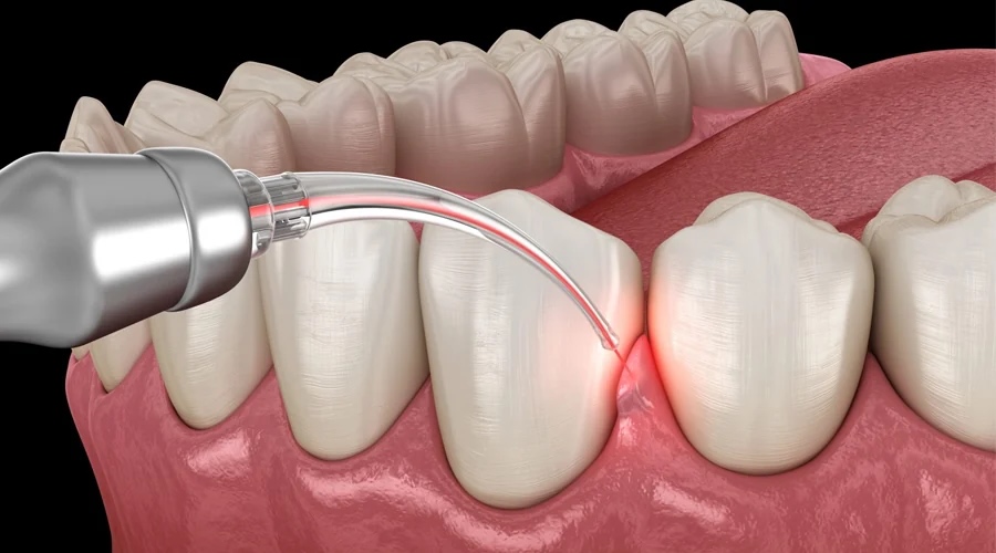 cắt lợi bằng laser